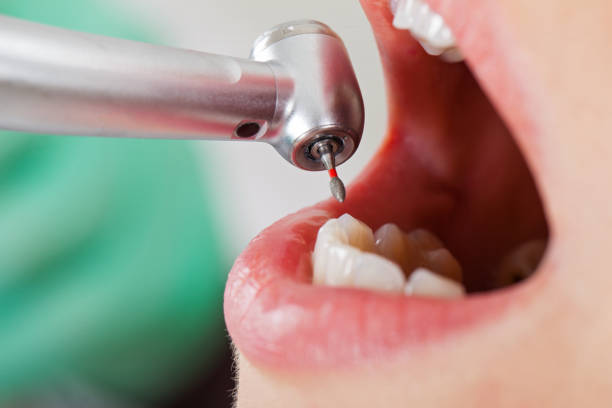 Best Emergency Root Canal Treatment in Mazon, IL